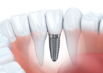 Dental Implants in Calgary